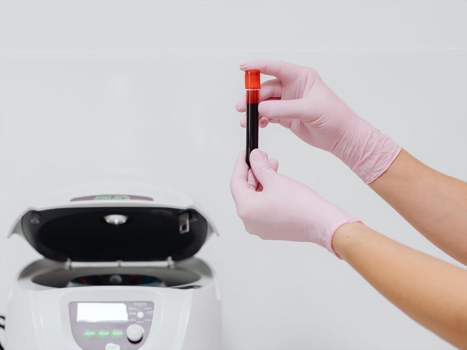 PRP Treatment